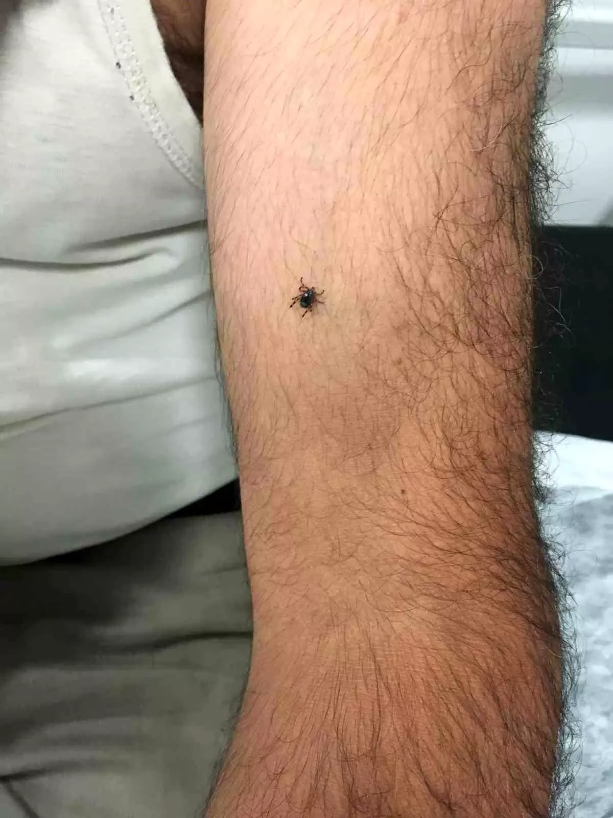 Kayseri'de İlk Kene Vakası: KKKA Şüphesiyle Gözetim Altında