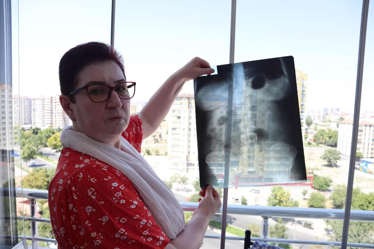 22 Yıldır Karnında Ameliyat İğnesiyle Yaşıyor