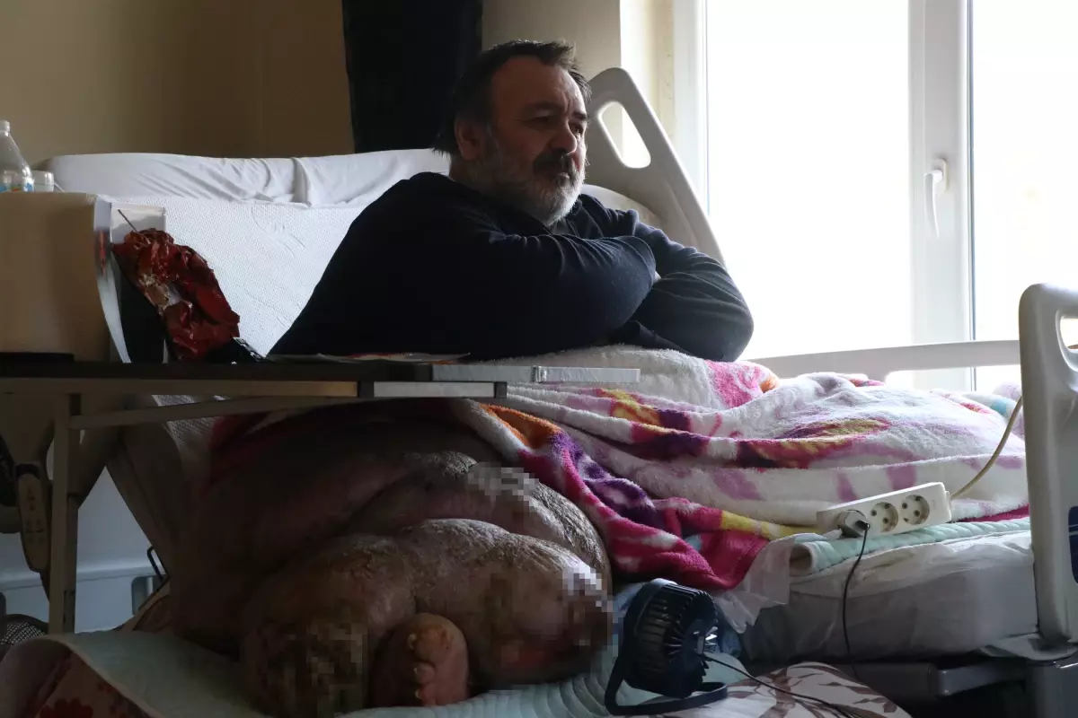 Fil Hastalığına Tedavi Başlıyor